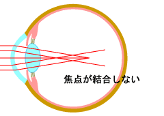 乱視眼の状態